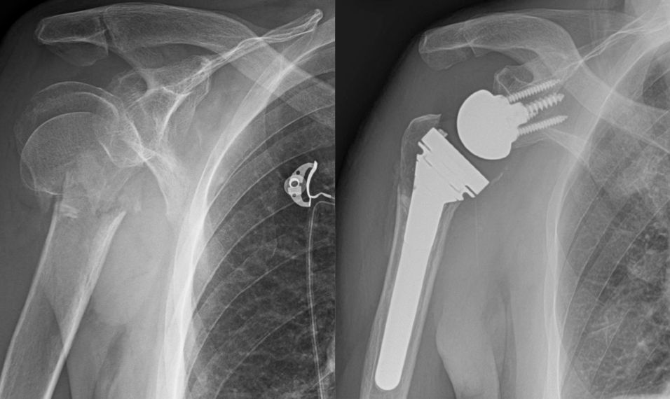 Proximal humerus fracture x ray by Orthopaedic Associates of Muskegon